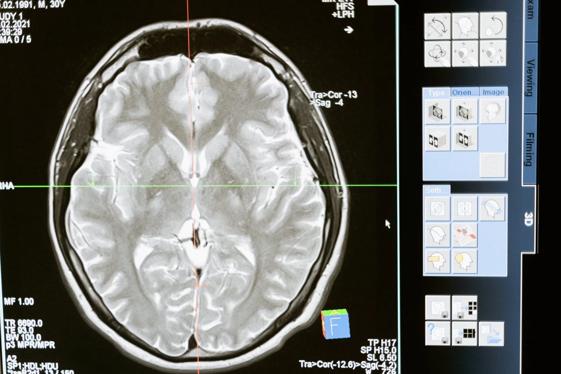 Concussion and Tinnitus